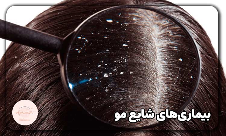 انواع بیماری های مو
