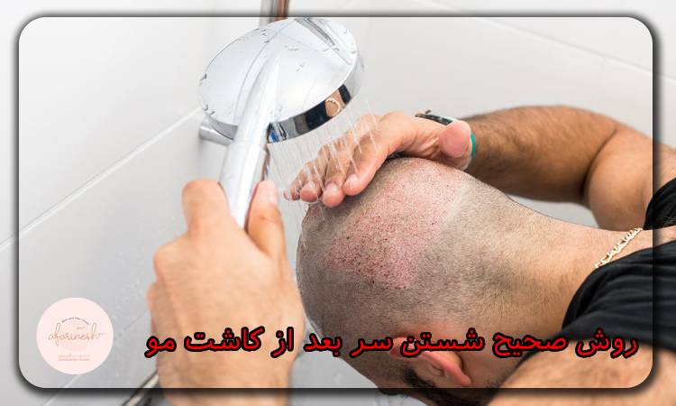 شستشوی سر بعد از کاشت مو
