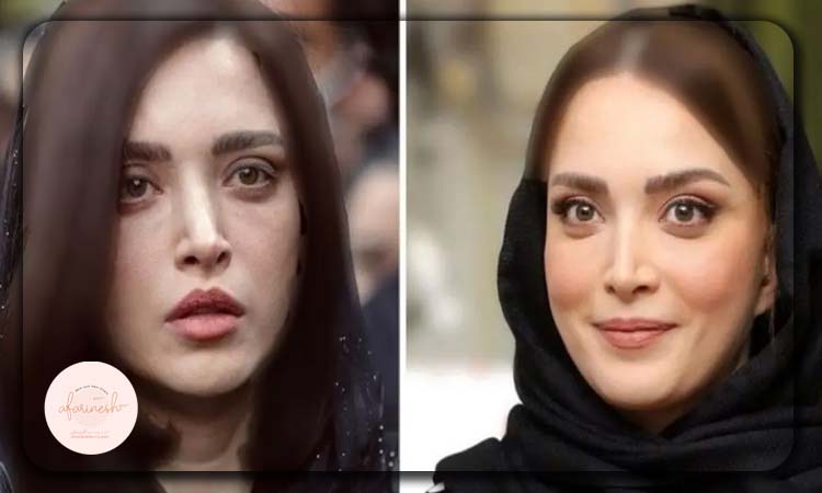 بهنوش طباطبایی قبل و بعد از عمل چشم