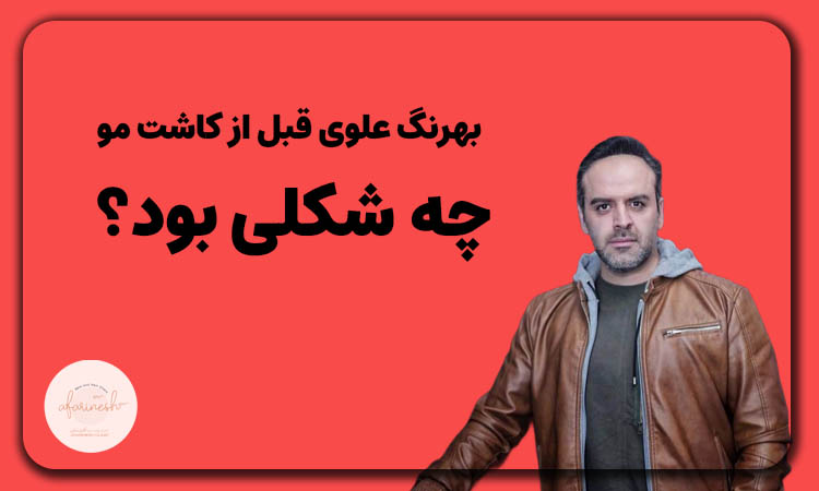 بهرنگ علوی قبل کاشت مو