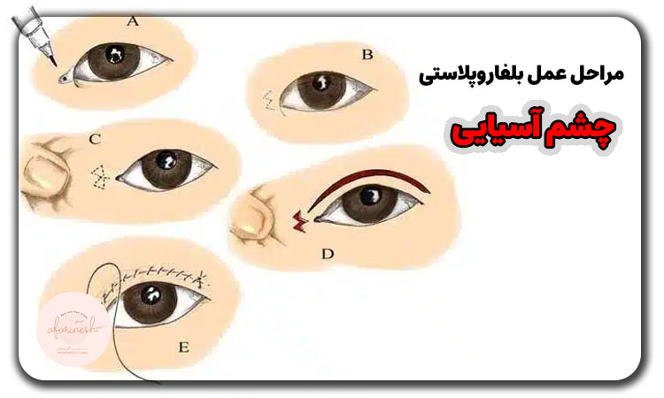 مراحل بلفاروپلاستی چشم آسیایی