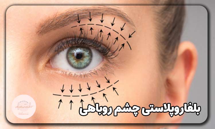 مراحل بلفاروپلاستی چشم روباهی