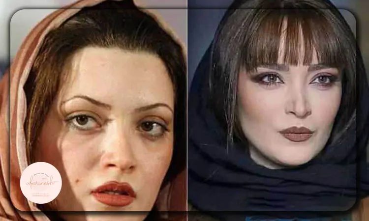 عکس قبل و بعد عمل چشم گربه ای بهنوش طباطبایی