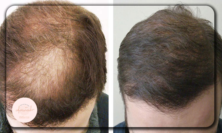 تصاویر بعد و قبل مزو مو
