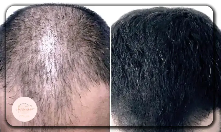 عکس قبل و بعد مزوتراپی مو