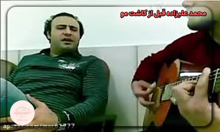 محمد علیزاده قبل از کاشت مو