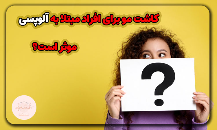 کاشت مو برای افراد مبتلا به آلوپسی موثر است؟