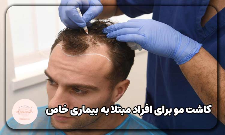 کاشت مو در افراد مبتلا به بیماری های خاص