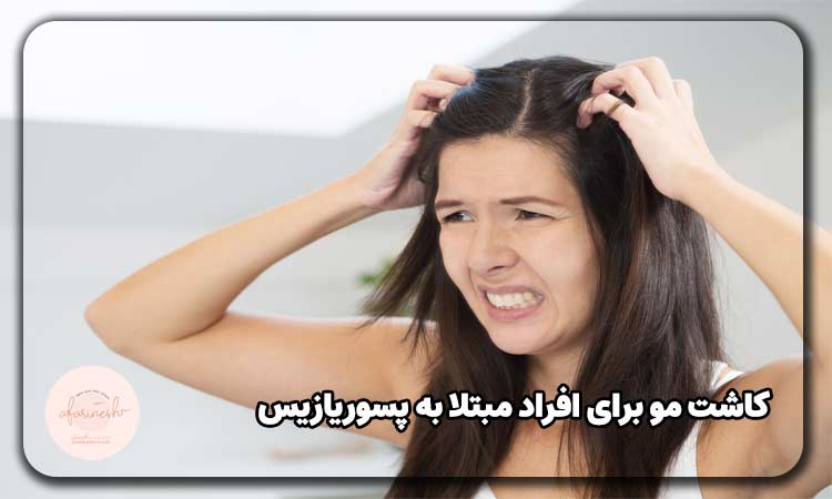 کاشت مو برای بیماران پسوریازیس