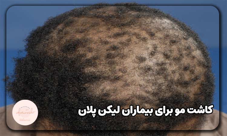 کاشت مو برای بیماران لیکن پلان