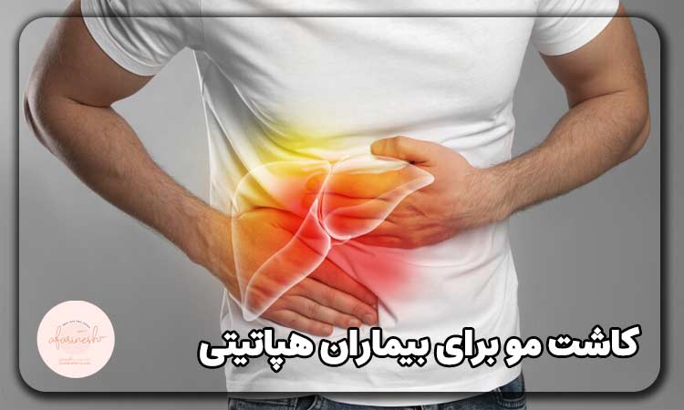 کاشت مو برای بیماران هپاتیتی