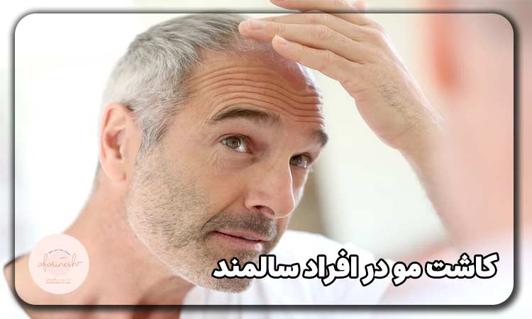 کاشت مو در افراد سالمند
