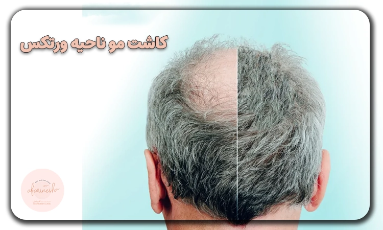کاشت مو وسط سر