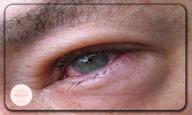 عوامل موثر بر ایجاد فشار چشم چیست؟
