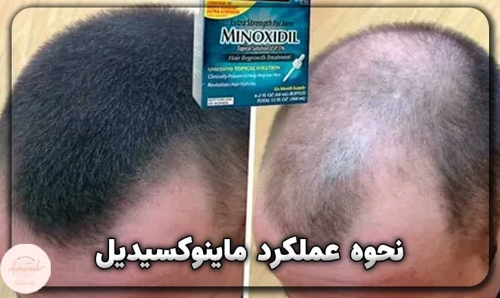 نحوه عملکرد ماینوکسیدیل