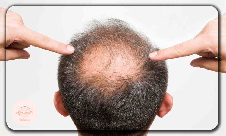 آیا کاشت مو برای بیماران هپاتیتی امکانپذیر است؟