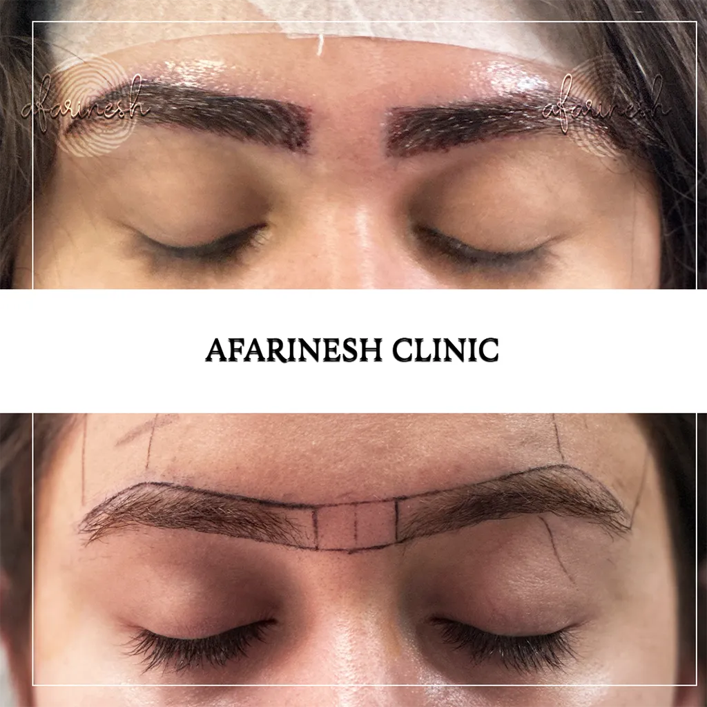 عکس قبل و بعد از کاشت ابرو طبیعی