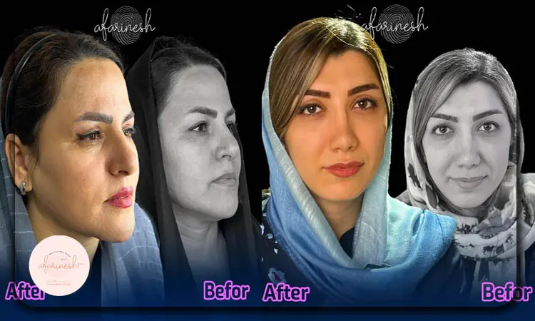 بلفاروپلاستی پلک بالا با لیزر بدون جراحی