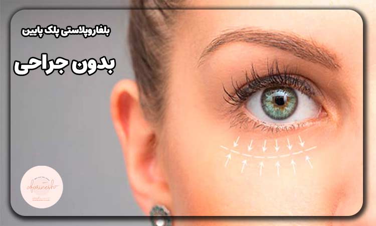 بلفاروپلاستی پلک پایین بدون جراحی