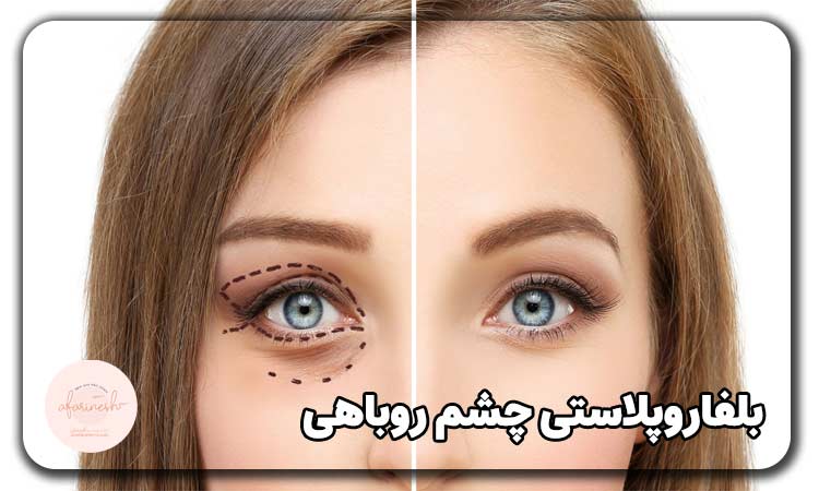 بلفاروپلاستی چشم روباهی