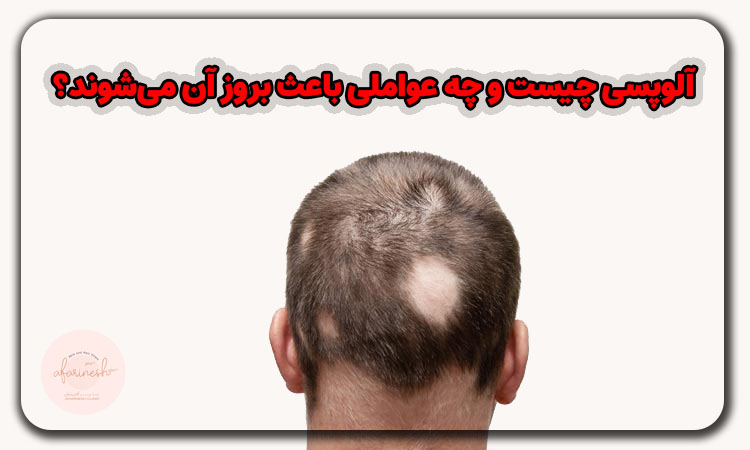 آلوپسی چیست