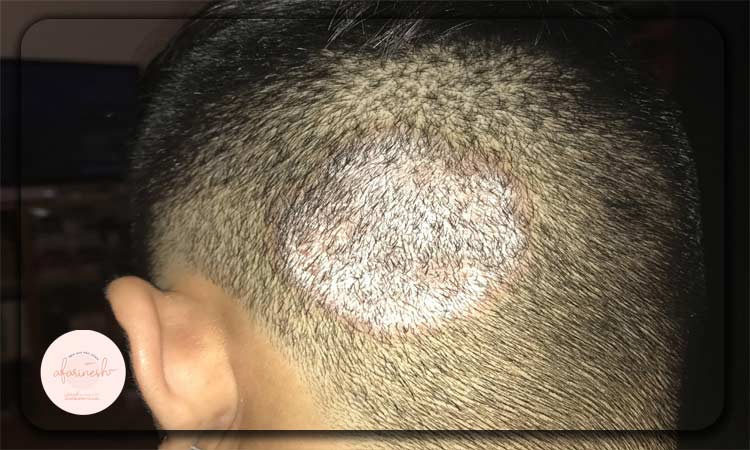 پسوریازیس چیست؟