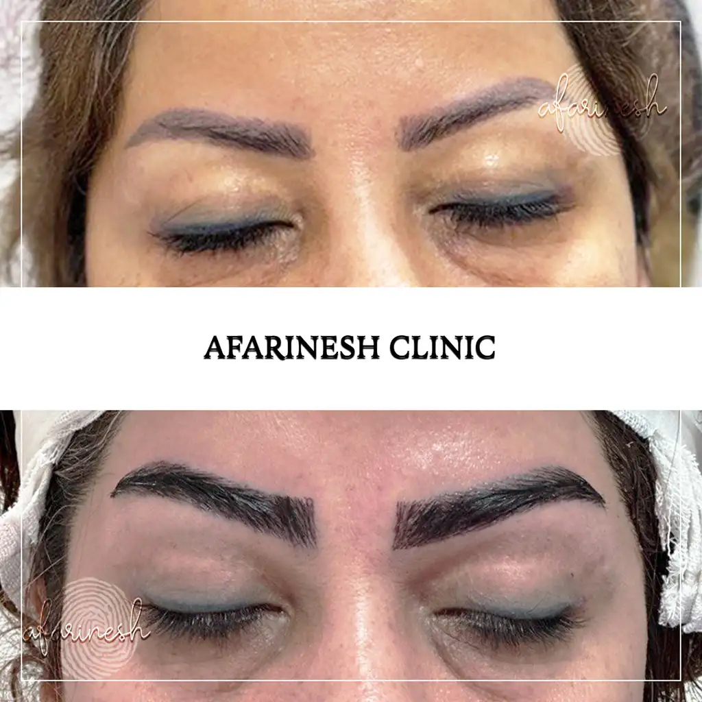 عکس کاشت ابرو بعد از یک ماه