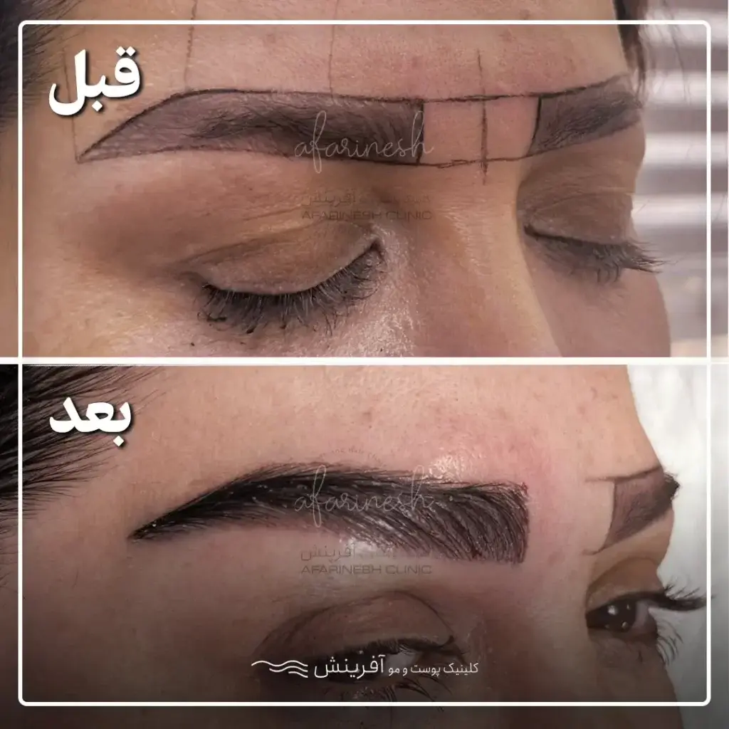 عکس کاشت ابرو بعد از یک ماه