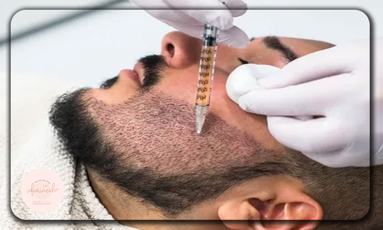 برای کاشت ریش از کجا مو بر میدارن