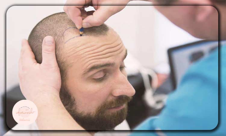 خطرات کاشت مو برای بیماران ایدزی