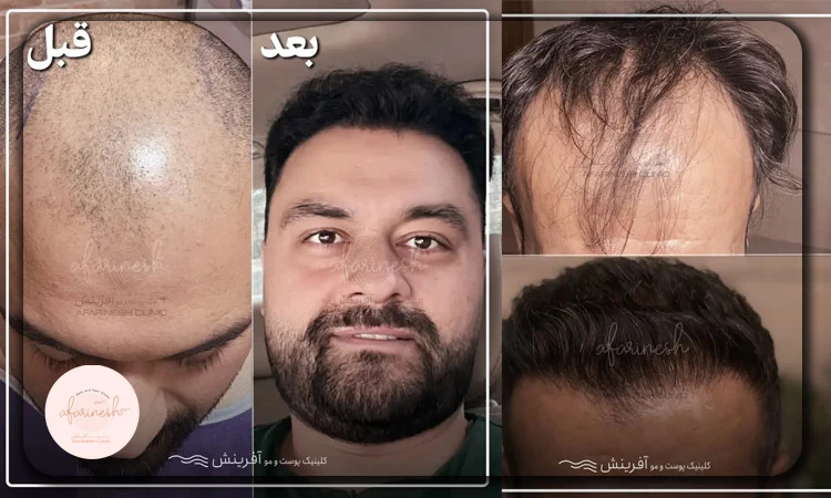 کاشت مو لا به لای موها