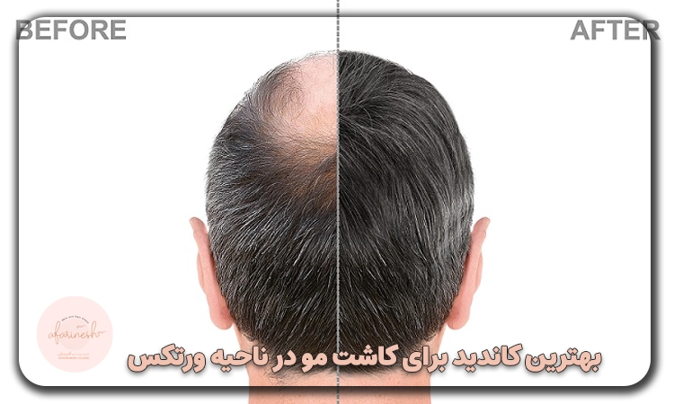 کاندیدا برای کاشت مو در ناحیه ورتکس
