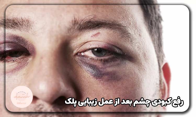 رفع کبودی چشم بعد از عمل زیبایی پلک