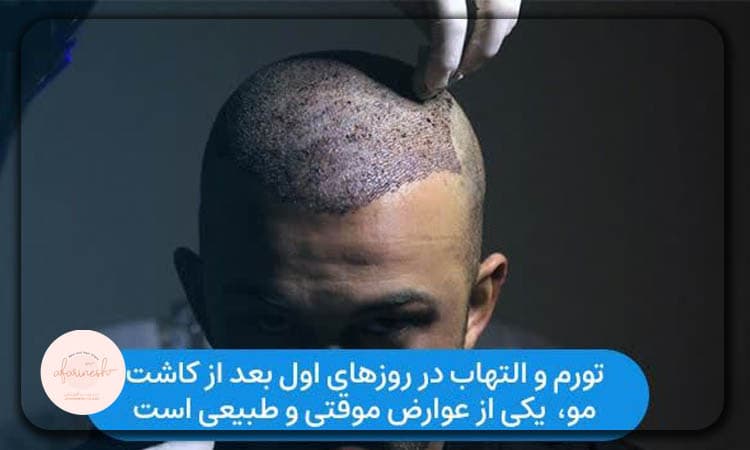 عوارض کوتاه مدت کاشت مو میکروگرافت
