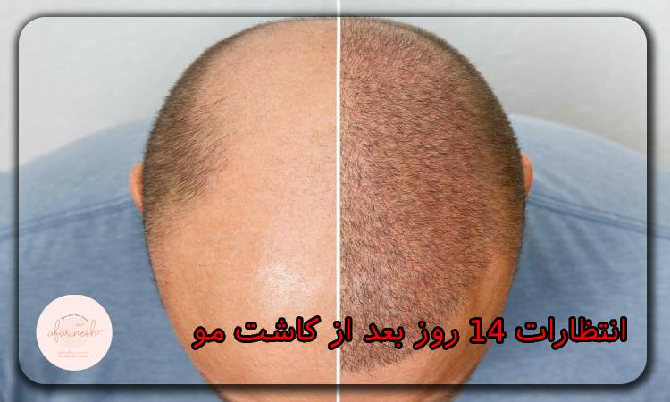 ۱۴ روز بعد از کاشت مو