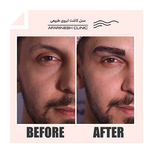 نمونه کار قبل و بعد از کاشت ابرو