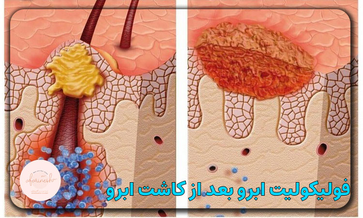 فولیکولیت بعد از کاشت ابرو