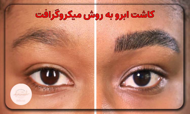 کاشت ابرو به روش میکروگرافت