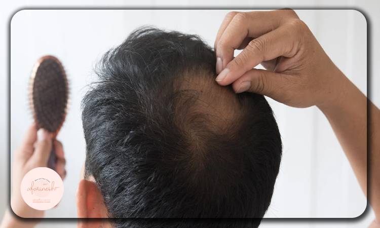 چرا بانک موی ضعیف میتواند مانع کاشت مو شود؟