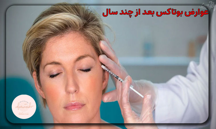 عوارض بوتاکس بعد از چند سال