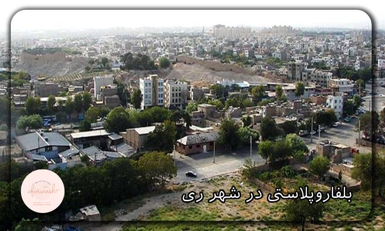 بلفاروپلاستی در شهر ری