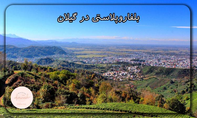 بلفاروپلاستی در گیلان