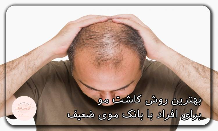 بهترین روش کاشت مو برای افراد با بانک موی ضعیف