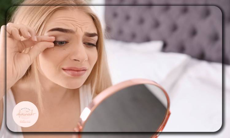 علت ریزش مژه بعد از بلفاروپلاستی