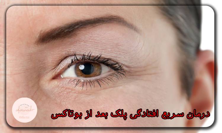 درمان سریع افتادگی پلک بعد از بوتاکس چیست؟