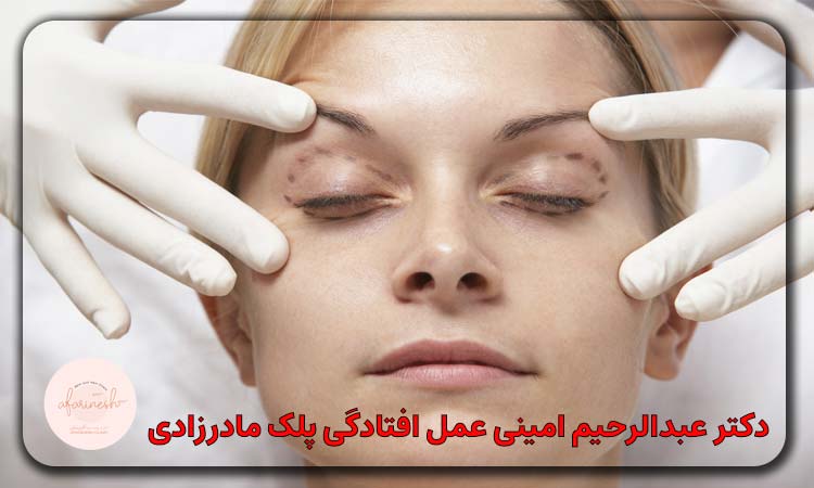 دکتر عبدالرحیم امینی عمل افتادگی پلک مادرزادی انجام می دهند