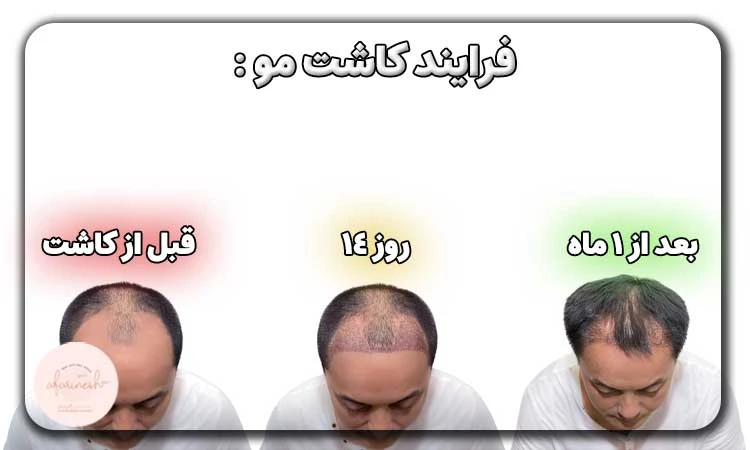 عکس 14 روز بعد از کاشت مو