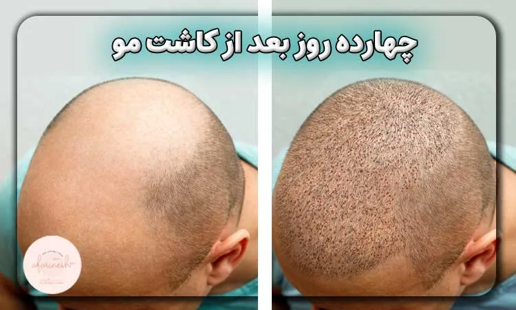 عکس چهارده روز بعد از کاشت مو