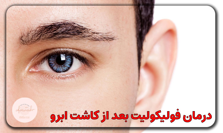 درمان فولیکولیت بعد از کاشت ابرو
