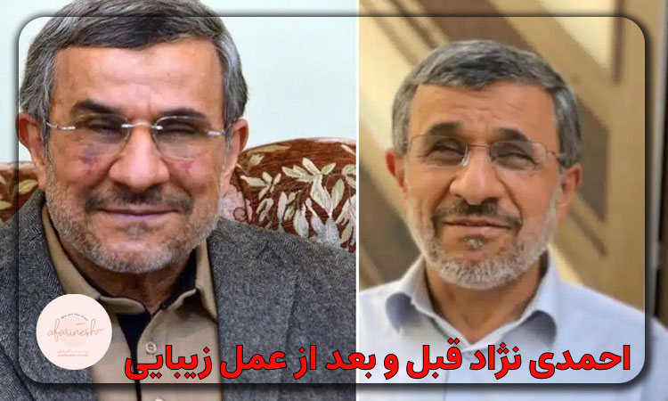 احمدی نژاد قبل و بعد از عمل زیبایی